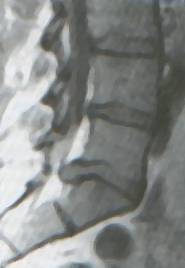 bandscheibe_thomas